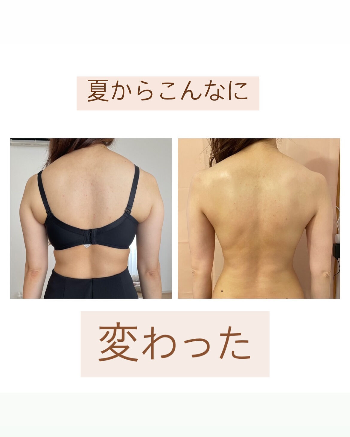 ラジオ波の効果についてと、